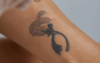 Eliminación de Tatuajes en Málaga y Torremolinos: Innovación en Medicina Estética
